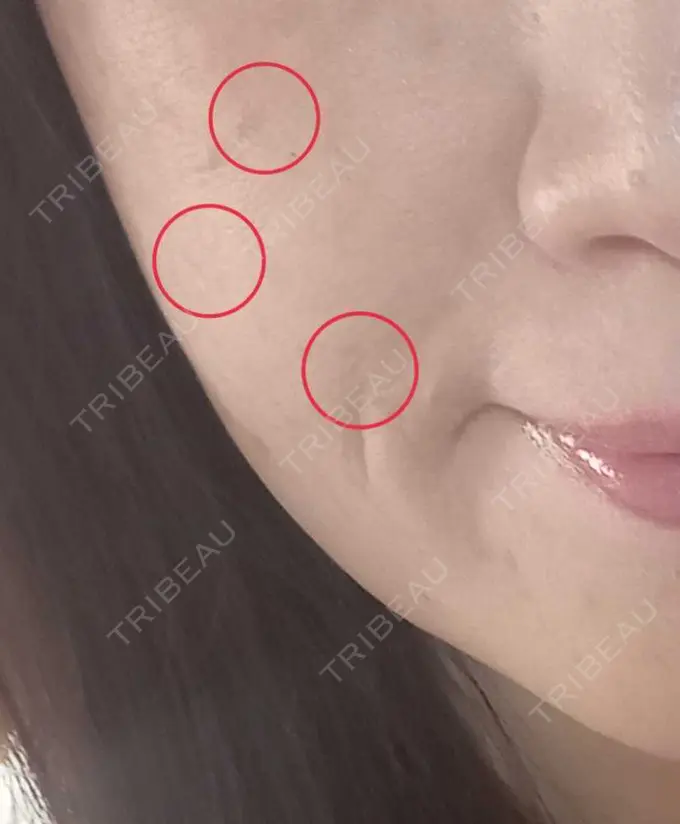 ほくろ・いぼ切除（肌） 品川美容外科 仙台院 DAY 18 メイン用