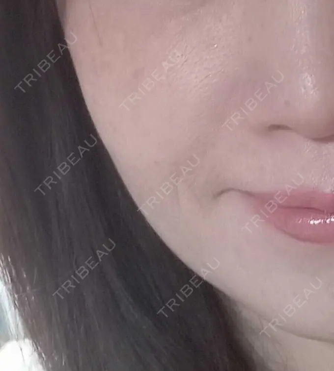 ほくろ・いぼ切除（肌） 品川美容外科 仙台院 AFTER メイン用