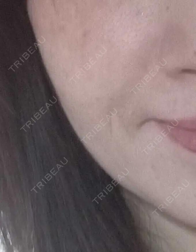 ほくろ・いぼ切除（肌） 品川美容外科 仙台院 DAY 18 メイン用