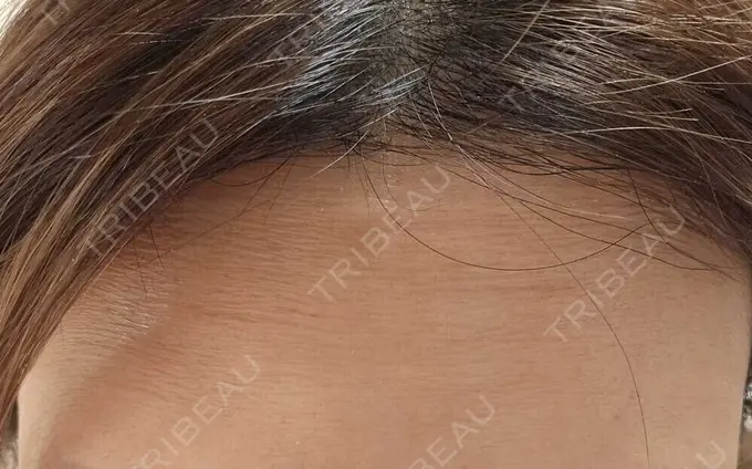 ボトックス（額） TCB東京中央美容外科 町田院 DAY 3 メイン用