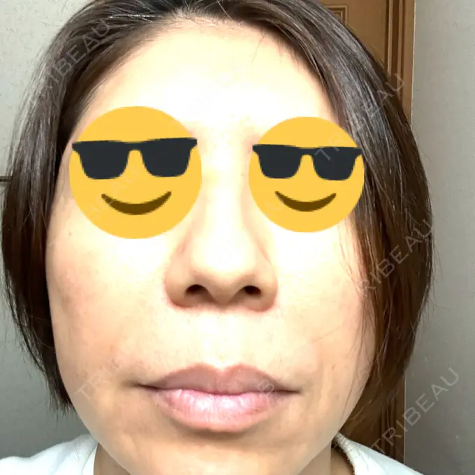 マイクロボトックス ルラ美容クリニック 千葉院 / ルラスキンクリニック 千葉院 AFTER メイン用