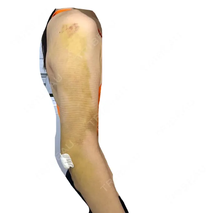 脂肪吸引（二の腕） / 脂肪吸引（肩） BBC銀座院 DAY 4 メイン用