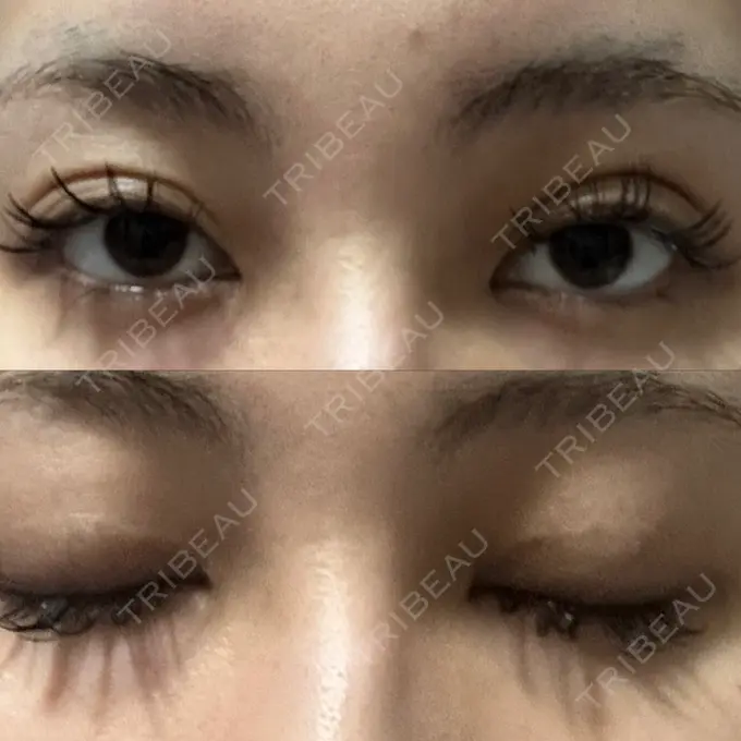 二重埋没 / クマ治療 ASTRA BEAUTY CLINIC DAY 750 メイン用