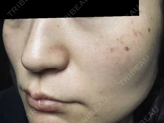 ピコスポット お茶の水美容形成クリニック DAY 5 メイン用