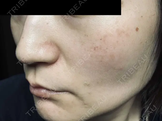 ピコスポット お茶の水美容形成クリニック DAY 6 メイン用