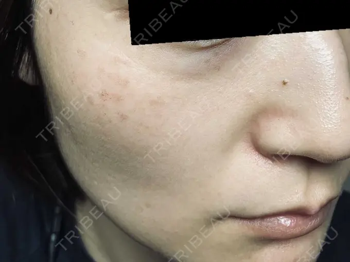 ピコスポット お茶の水美容形成クリニック DAY 6 メイン用