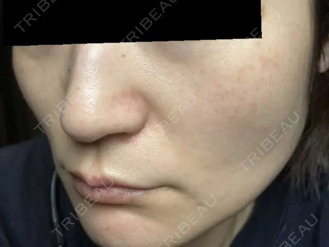 ピコスポット お茶の水美容形成クリニック DAY 7 メイン用