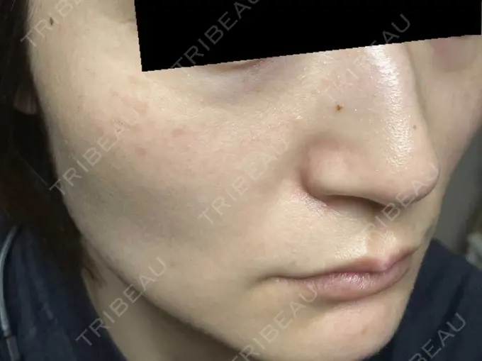 ピコスポット お茶の水美容形成クリニック DAY 7 メイン用