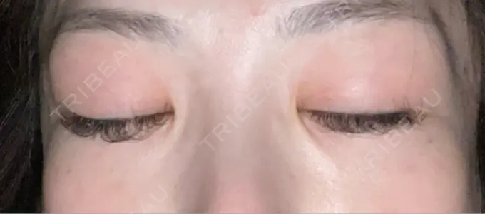 シワ取りボトックス TCB東京中央美容外科 神戸院 DAY 1 メイン用