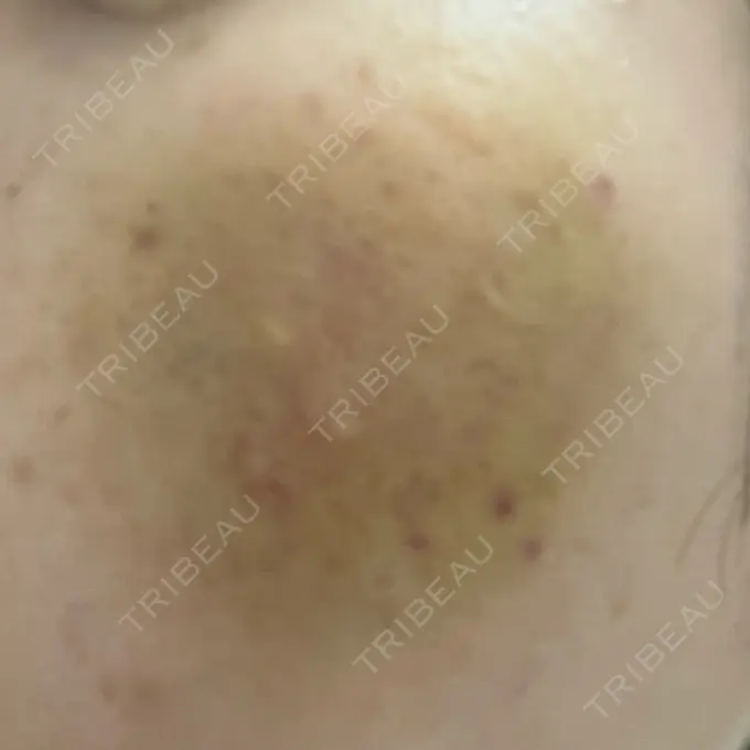 サブシジョン / 肌育注射（ジュベルックなど） / その他（肌） ゆきスキンクリニック 東池袋 DAY 3 メイン用