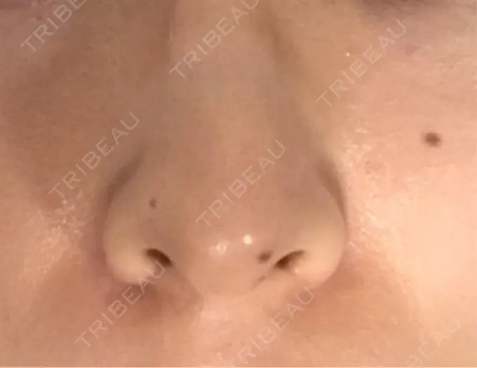 ピーリング（ニキビ・毛穴） / 美肌レーザー / シミ取りレーザー / 美白レーザー / 毛穴洗浄（ハイドラフェイシャルなど） / ピコレーザートーニング（美白・肝斑） / レーザートーニング（美白・肝斑） / レーザーフェイシャル / ピーリング（ハリ・ツヤ） LE CLINIC DAY 13 メイン用