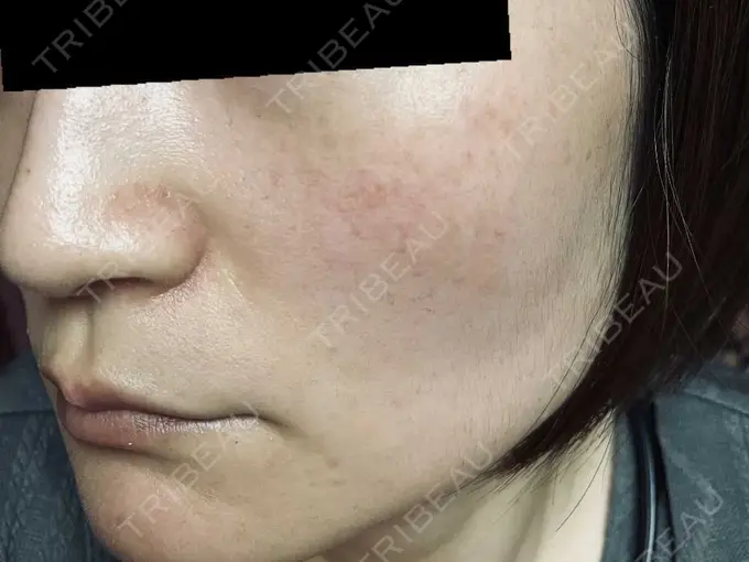 ピコスポット お茶の水美容形成クリニック DAY 8 メイン用