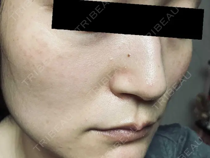 ピコスポット お茶の水美容形成クリニック DAY 8 メイン用