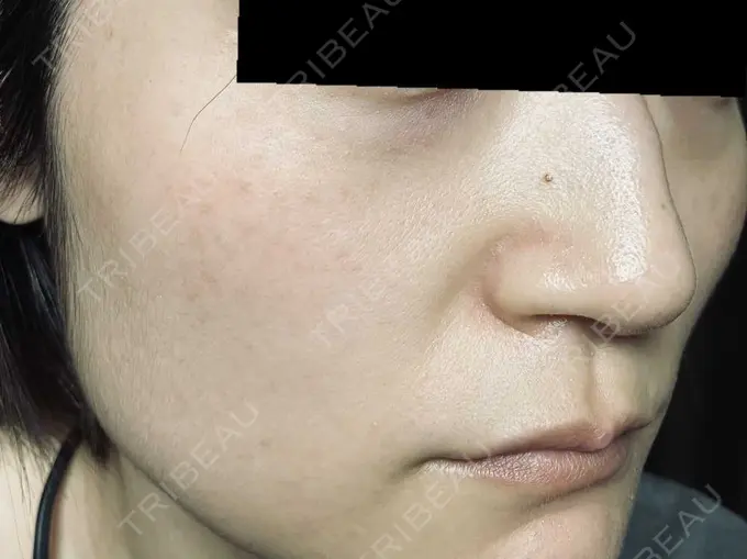 ピコスポット お茶の水美容形成クリニック DAY 14 メイン用