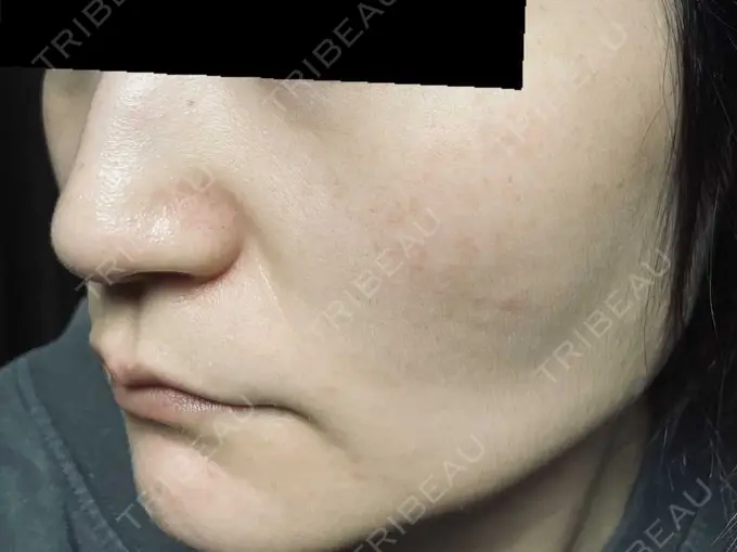 ピコスポット お茶の水美容形成クリニック AFTER メイン用