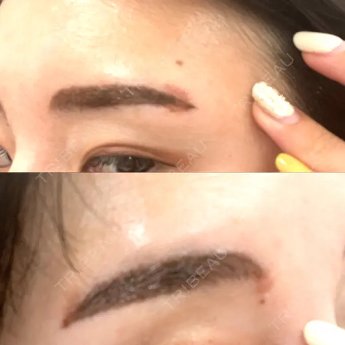 アートメイク（眉） 椿クリニック 心斎橋院 DAY 8 メイン用