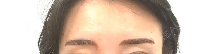 アートメイク（眉） 椿クリニック 心斎橋院 DAY 8 メイン用