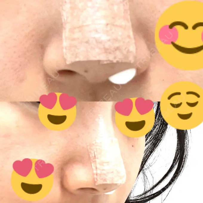 軟骨移植 R.O.clinic DAY 1 メイン用