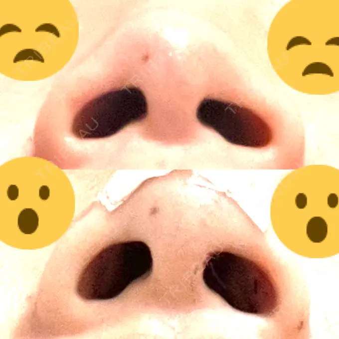 軟骨移植 R.O.clinic DAY 3 メイン用