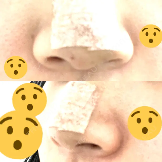 軟骨移植 R.O.clinic DAY 3 メイン用