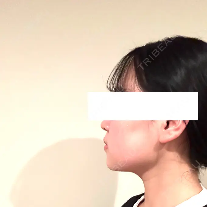 脂肪吸引（顔） / ボトックス（エラ・小顔） Mods Clinic（モッズクリニック） 名古屋院 DAY 28 メイン用