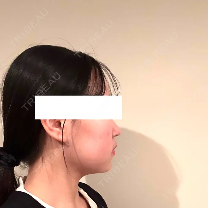 脂肪吸引（顔） / ボトックス（エラ・小顔） Mods Clinic（モッズクリニック） 名古屋院 DAY 28 メイン用