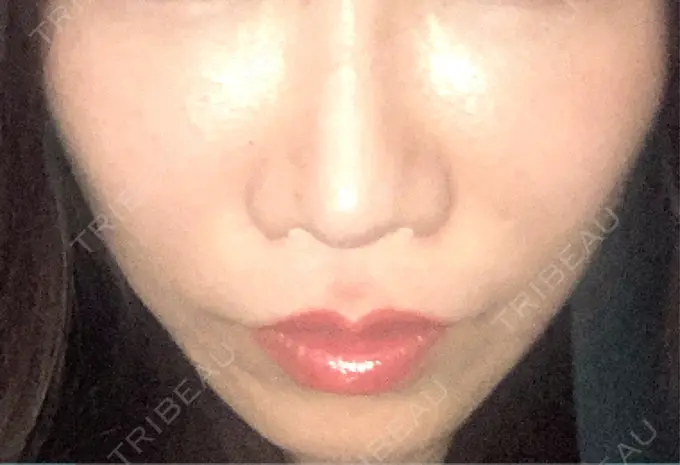 ボトックス（エラ・小顔） / ヴェルヴェットスキン おおたかの森ビューティークリニック DAY 3 メイン用