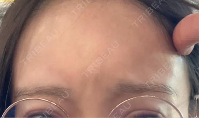 ボトックス（眉間） レナトゥスクリニック 東京田町院 DAY 37 メイン用