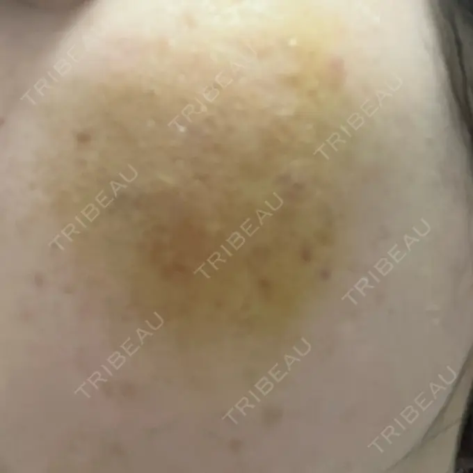 サブシジョン / 肌育注射（ジュベルックなど） / その他（肌） ゆきスキンクリニック 東池袋 DAY 4 メイン用