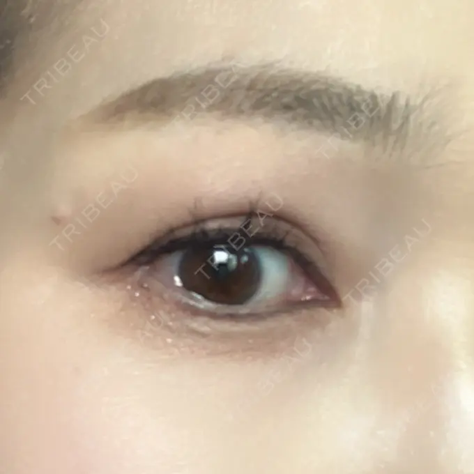 眉下切開 湘南美容クリニック 秋葉原院 DAY 1766 メイン用