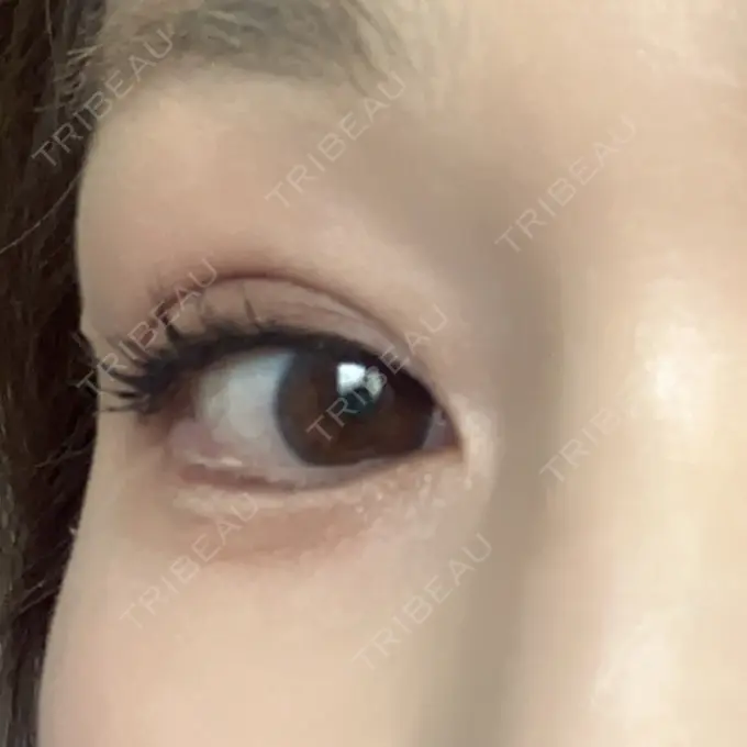 眉下切開 湘南美容クリニック 秋葉原院 DAY 1766 メイン用