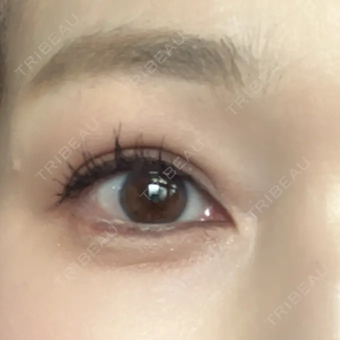 眉下切開 湘南美容クリニック 秋葉原院 AFTER メイン用