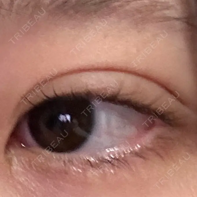 二重埋没 仙台N美容クリニック DAY 0 メイン用