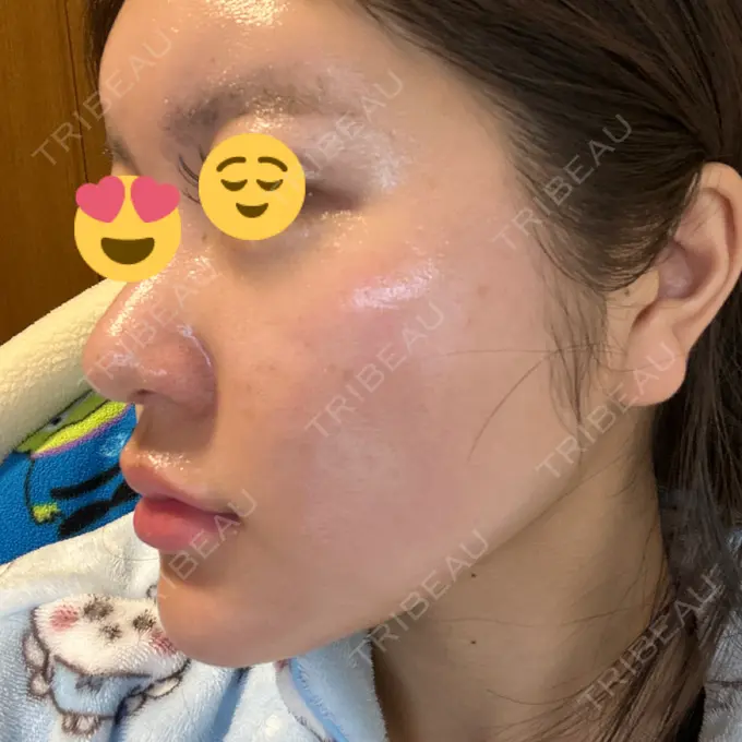 ヒアルロン酸注入（鼻翼基部） THE FIRST CLINIC 町田院 DAY 23 メイン用