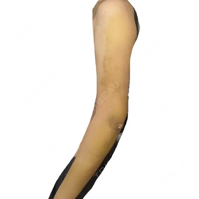 脂肪吸引（二の腕） / 脂肪吸引（肩） BBC銀座院 DAY 6 メイン用