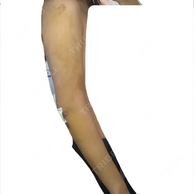 脂肪吸引（二の腕） / 脂肪吸引（肩） BBC銀座院 DAY 6 メイン用