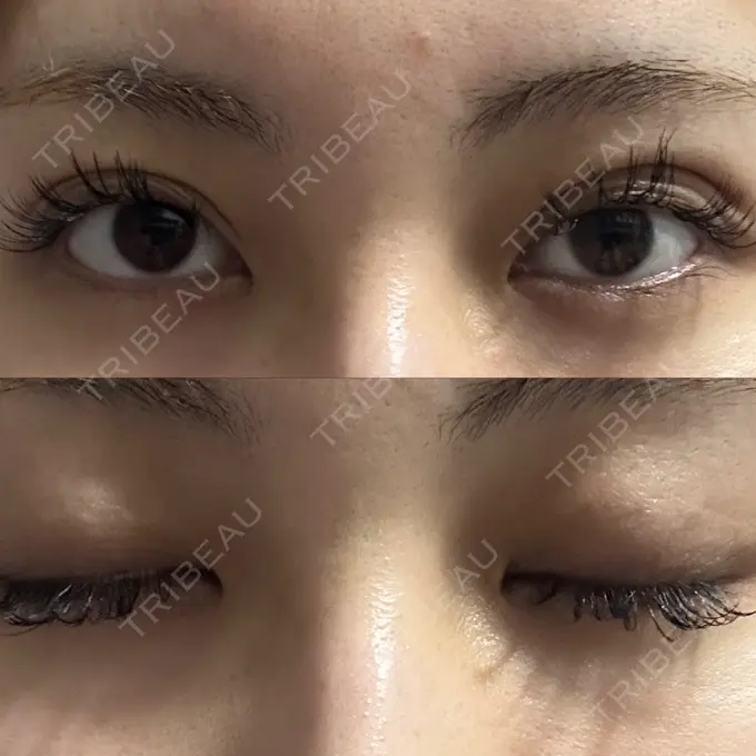 二重埋没 / クマ治療 ASTRA BEAUTY CLINIC DAY 752 メイン用