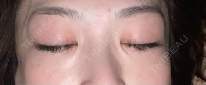 シワ取りボトックス TCB東京中央美容外科 神戸院 DAY 3 メイン用