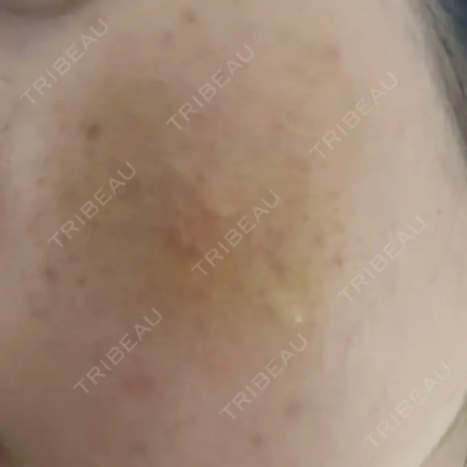 サブシジョン / 肌育注射（ジュベルックなど） / その他（肌） ゆきスキンクリニック 東池袋 DAY 5 メイン用