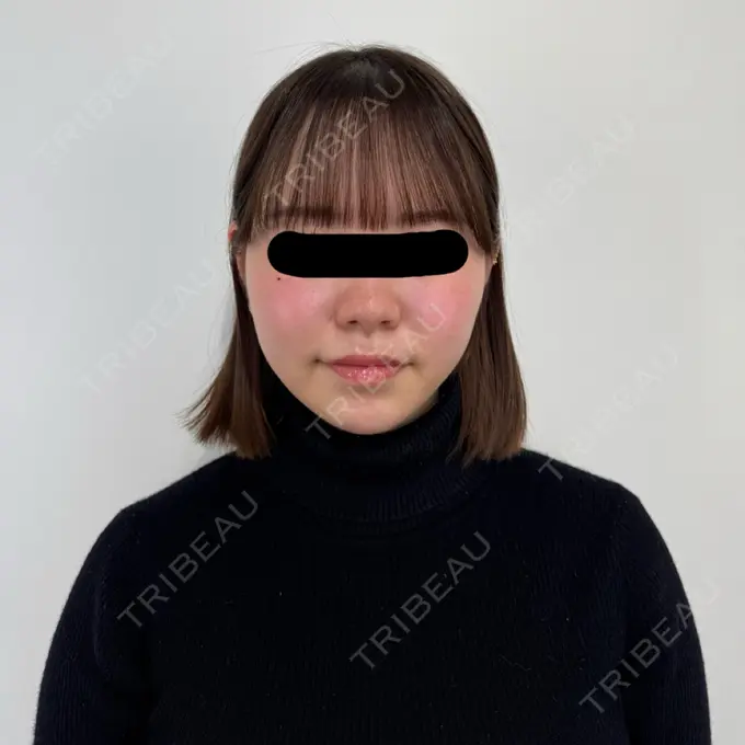 脂肪吸引（顔） / 脂肪吸引注射（顔） SEA CLINIC（シークリニック） DAY 83 メイン用