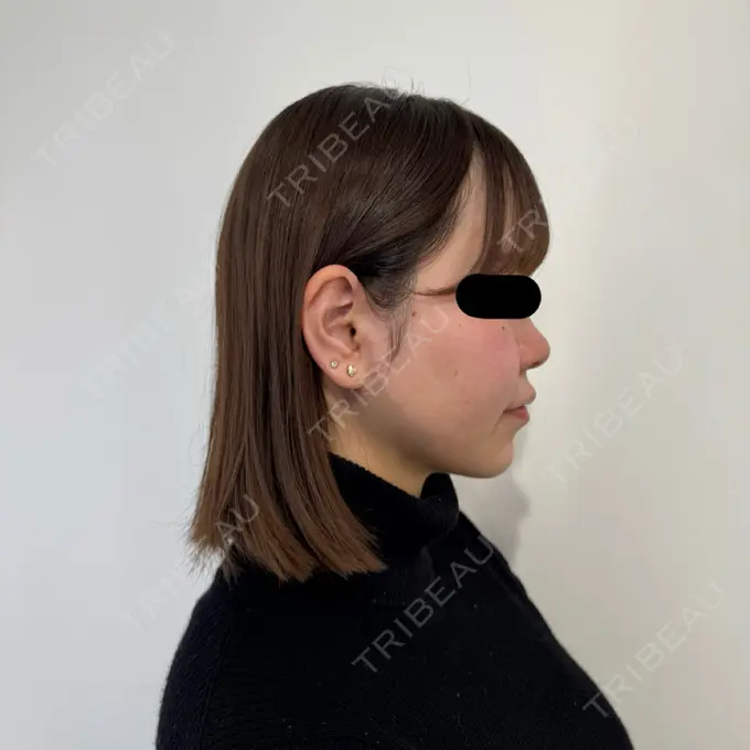 脂肪吸引（顔） / 脂肪吸引注射（顔） SEA CLINIC（シークリニック） DAY 83 メイン用