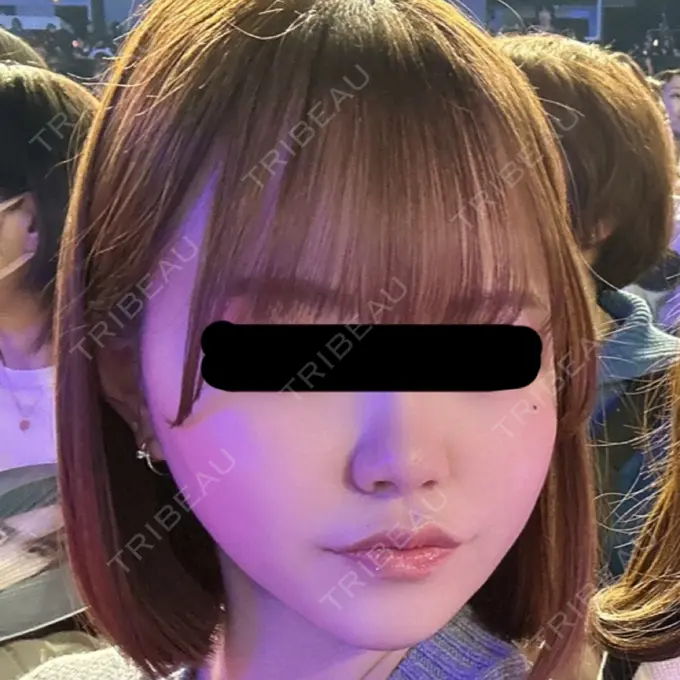 脂肪吸引（顔） / 脂肪吸引注射（顔） SEA CLINIC（シークリニック） DAY 31 メイン用