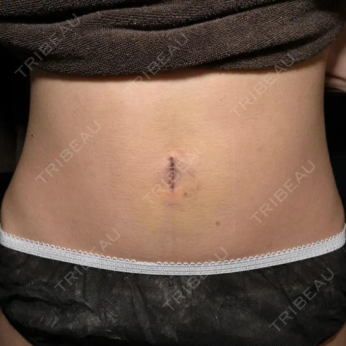 へそ形成 藤・ナチュレ美容クリニック 銀座院 DAY 7 メイン用