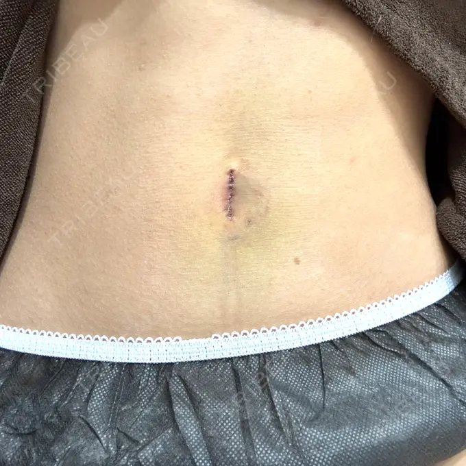 へそ形成 藤・ナチュレ美容クリニック 銀座院 DAY 7 メイン用