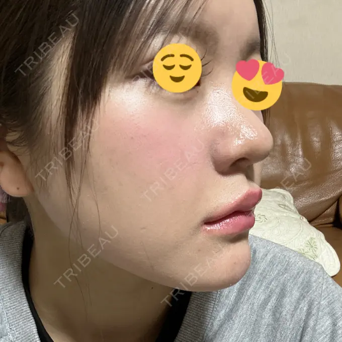 ヒアルロン酸注入（鼻翼基部） THE FIRST CLINIC 町田院 DAY 31 メイン用