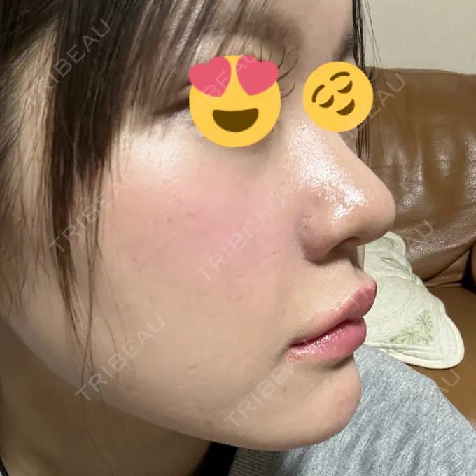 ヒアルロン酸注入（鼻翼基部） THE FIRST CLINIC 町田院 DAY 32 メイン用