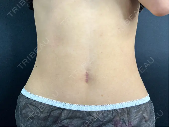 へそ形成 藤・ナチュレ美容クリニック 銀座院 AFTER メイン用
