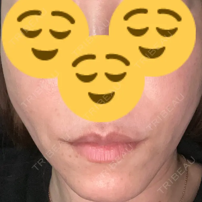 糸リフト DMTC CLINIC 日本橋院 DAY 13 メイン用