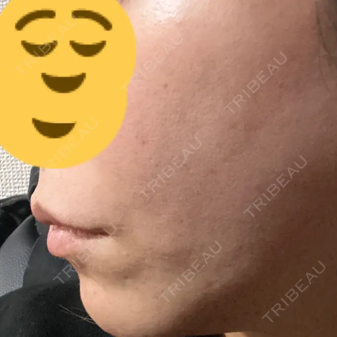 糸リフト DMTC CLINIC 日本橋院 DAY 13 メイン用