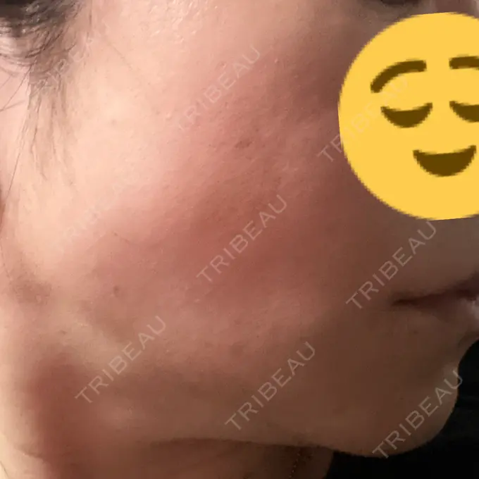 糸リフト DMTC CLINIC 日本橋院 DAY 13 メイン用